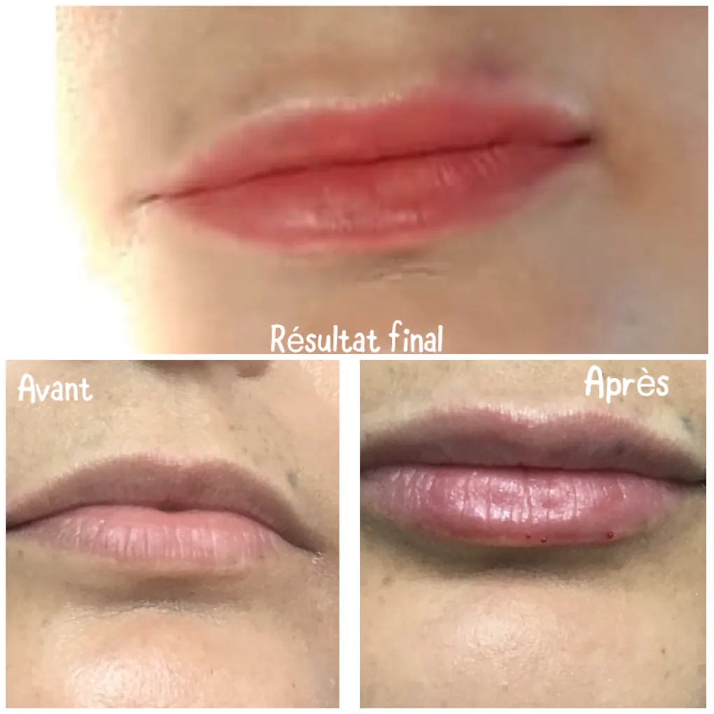 Avant/après injection des lèvres à l'acide hyaluronique — Dr El Mesbahi, dermatologue Casablanca