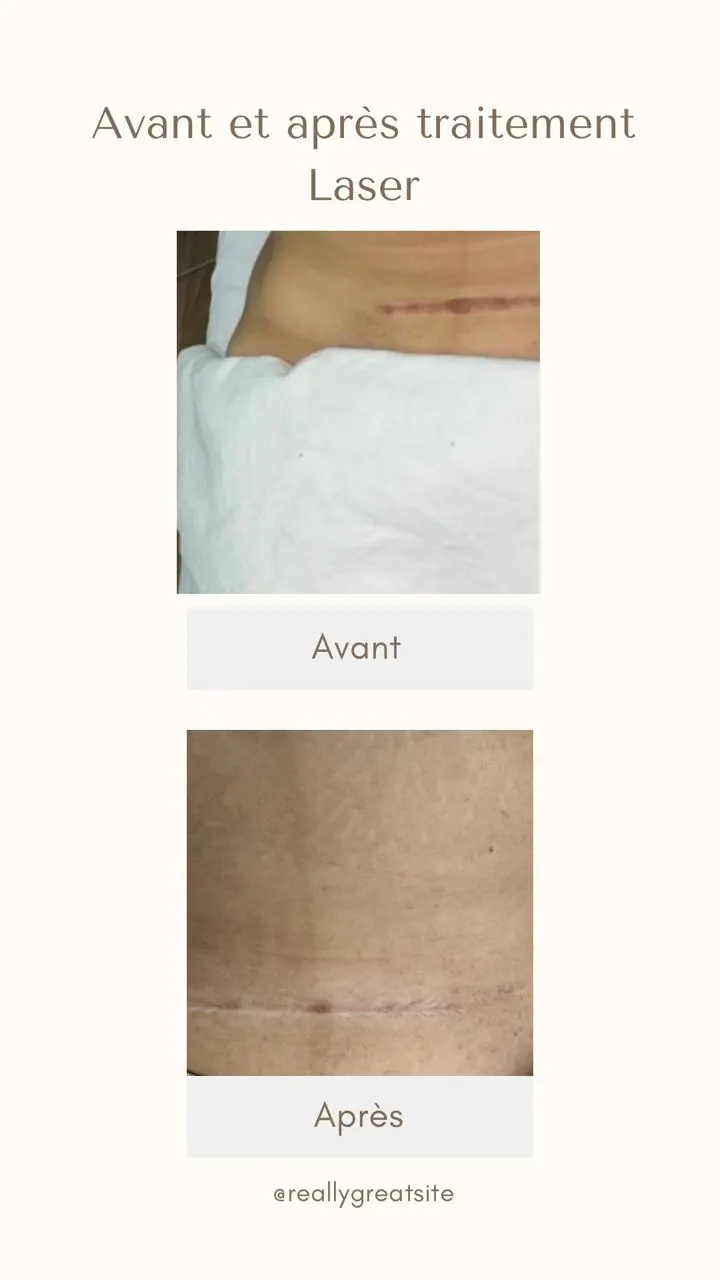 Avant/après laser cicatrice — cabinet dermatologie Ain Chock