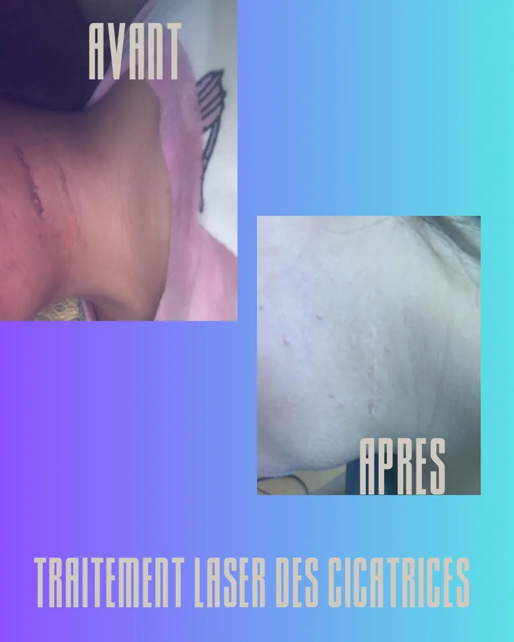 Avant/après traitement laser des cicatrices — dermatologue Casablanca