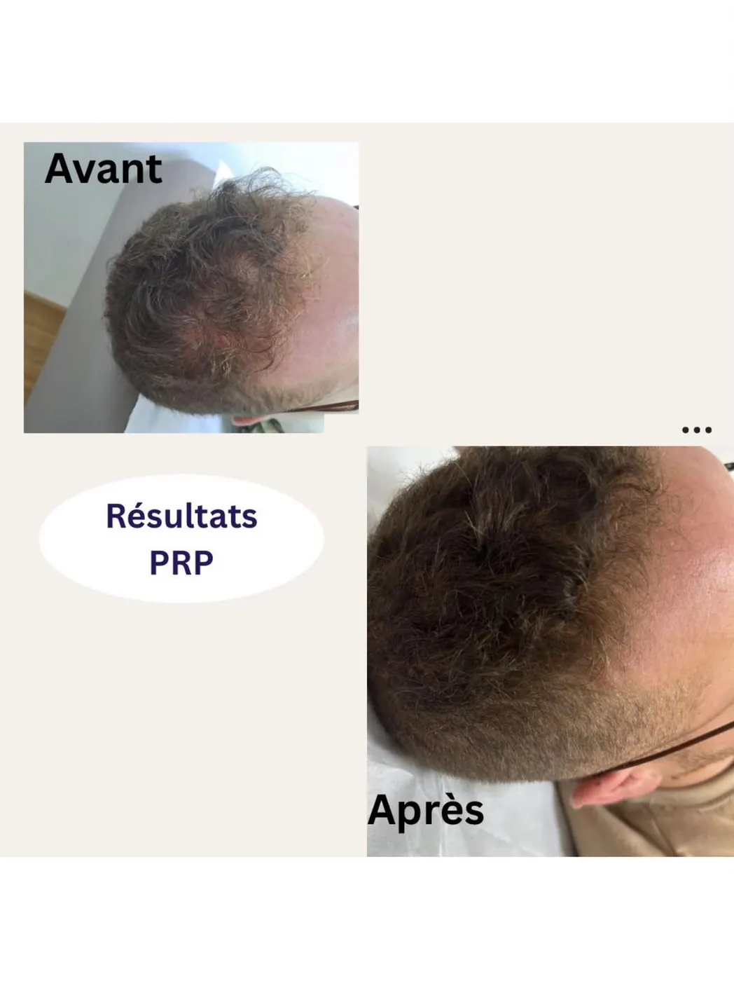 Avant/après PRP chute de cheveux — dermatologue Ain Chock Casablanca