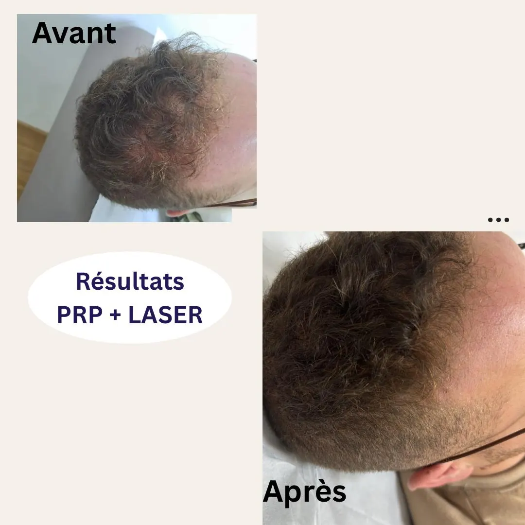 Avant/après PRP + laser cuir chevelu — dermatologue Casablanca