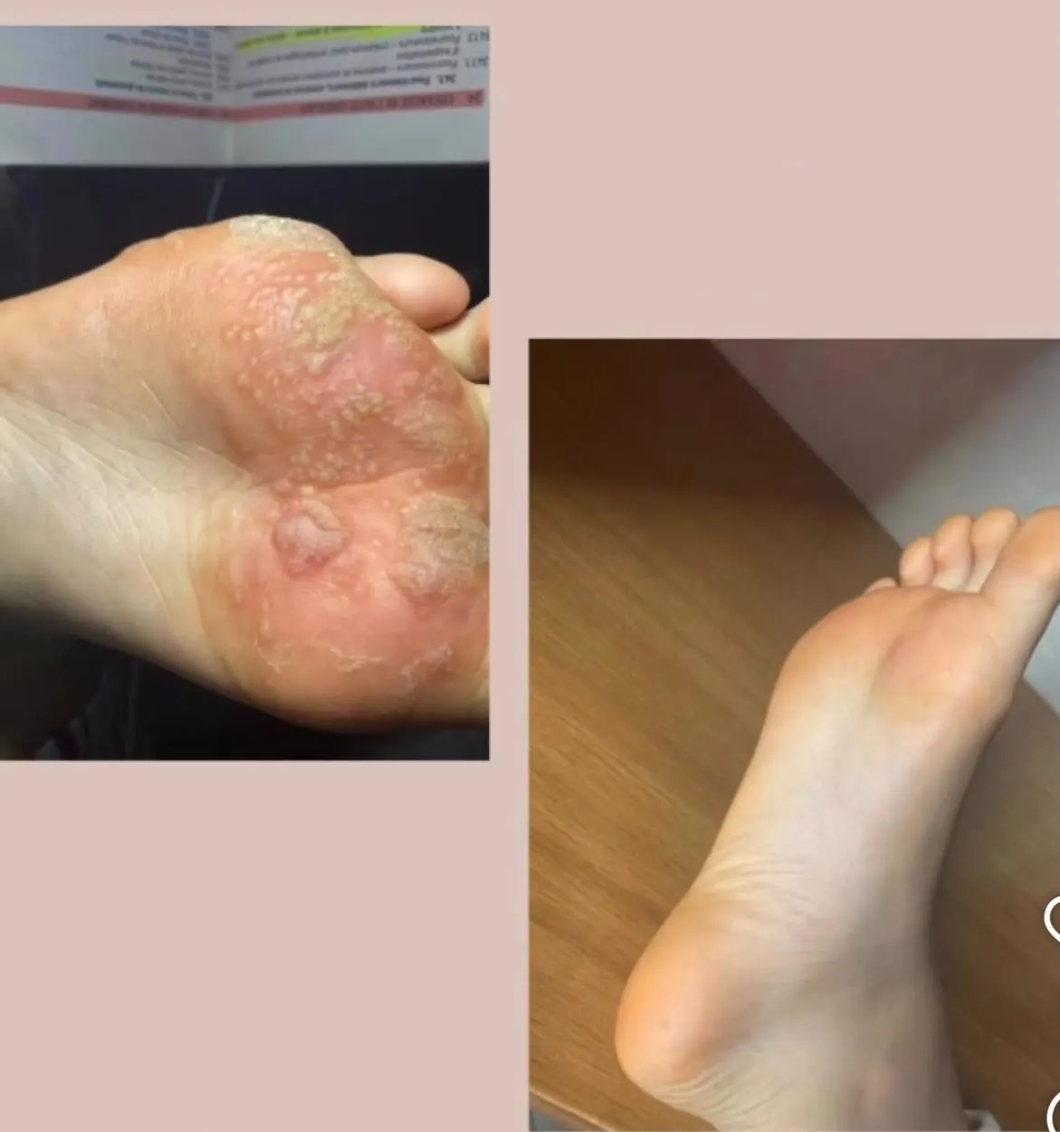 Avant/après traitement d'une lésion du pied — dermatologue Ain Chock
