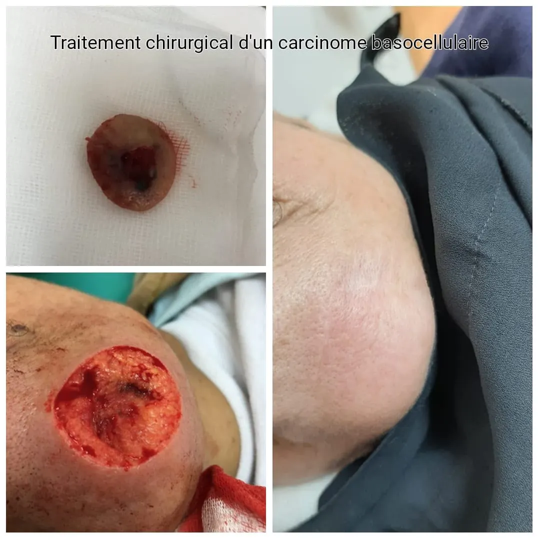 Chirurgie cancérologique dermatologique Casablanca