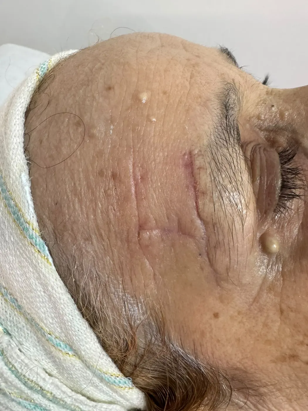 Chirurgie dermatologique Casablanca