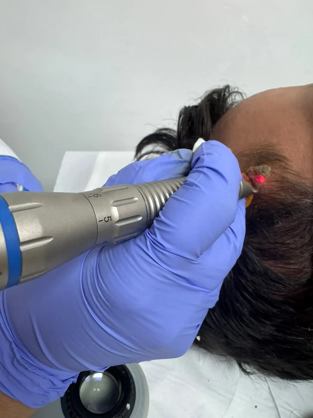 Laser dermatologique Casablanca