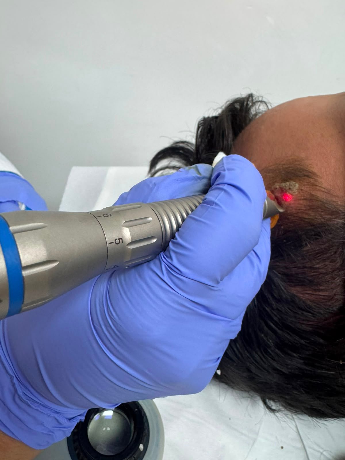Laser dermatologique Casablanca